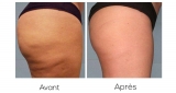 Les effets du gant de crin sur la cellulite